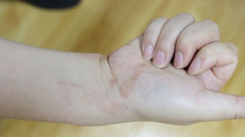 湿疹是怎样形成的？它的发病机制是怎样的？这3个常识你知道吗？(图1)