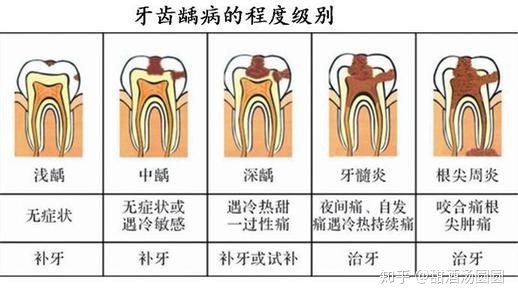 我在长沙市口腔医院补牙全过程及经验分享(图6)